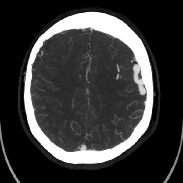 File:Cerebral arteriovenous malformation (Radiopaedia 43729-47189 B 35).jpg