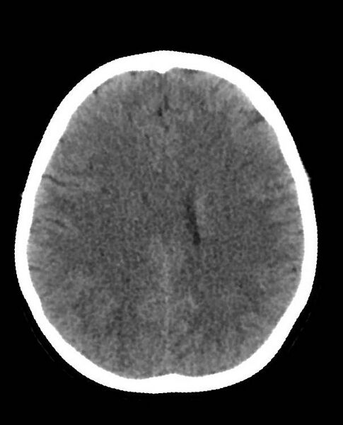 File:Cerebral edema due to severe hyponatremia (Radiopaedia 89826-106938 Axial non-contrast 66).jpg