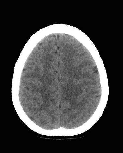 File:Cerebral edema due to severe hyponatremia (Radiopaedia 89826-106938 Axial non-contrast 79).jpg