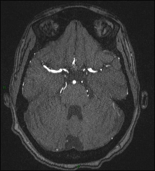 File:Cerebral fat embolism (Radiopaedia 35022-36525 Axial TOF 64).jpg