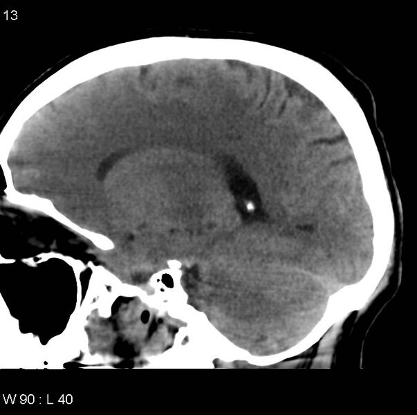 File:Cerebral hemorrhagic contusion with subdural and subarachnoid hemorrhage (Radiopaedia 10680-11146 C 6).jpg