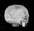 Cerebral hemorrhagic contusions (Radiopaedia 23145-23188 3D MIP 8).jpg