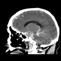Cerebral hemorrhagic contusions (Radiopaedia 23145-23188 C 26).jpg