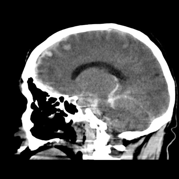 File:Cerebral hemorrhagic contusions (Radiopaedia 23145-23188 C 26).jpg
