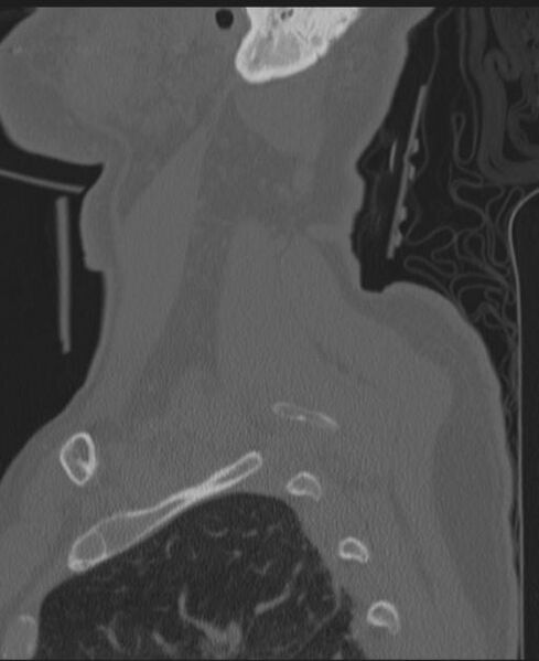 File:Cerebral hemorrhagic contusions and cervical spine fractures (Radiopaedia 32865-33841 Sagittal bone window 10).jpg
