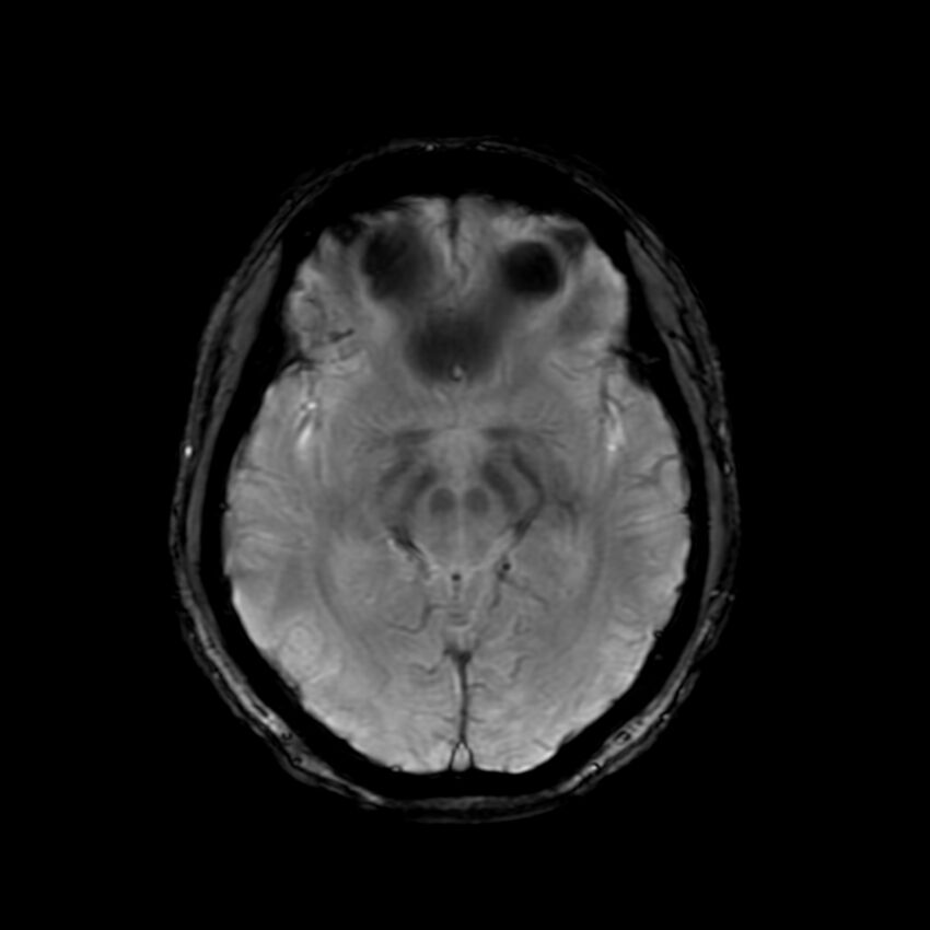 Cerebral paragonimiasis (Radiopaedia 73473-84238 Axial SWI 31).jpg