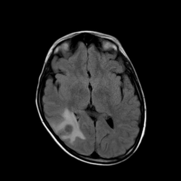 File:Cerebral tuberculoma (Radiopaedia 41152-43932 Axial FLAIR 11).jpg