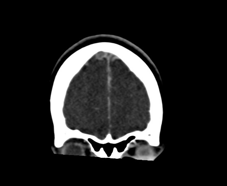 File:Cerebral venous sinus thrombosis (Radiopaedia 59224-66646 Coronal C+ delayed 6).jpg