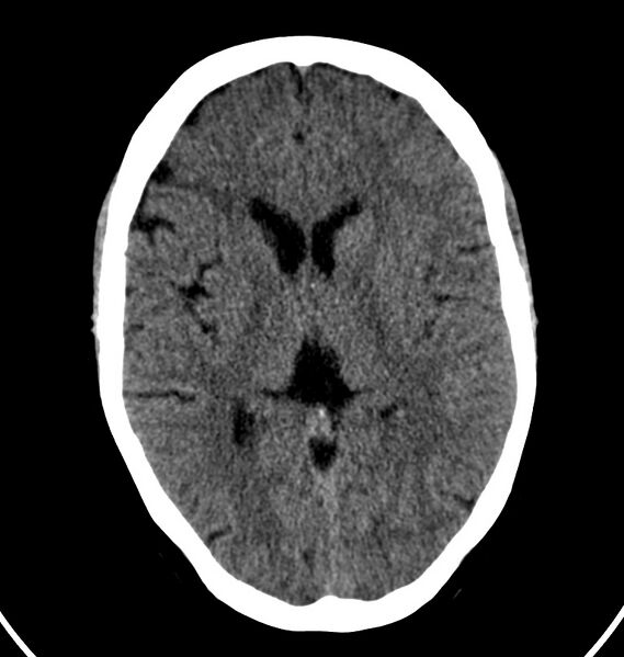 File:Cerebral venous thrombosis - CT only (Radiopaedia 41031-43778 Axial non-contrast 41).jpg