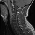 Cervical flexion teardrop fracture with cord hemorrhage (Radiopaedia 32497-33455 Sagittal T1 7).jpg