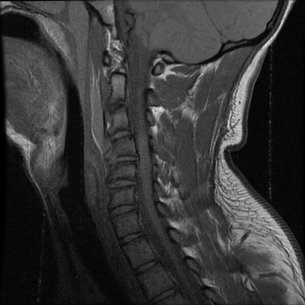 File:Cervical flexion teardrop fracture with cord hemorrhage (Radiopaedia 32497-33455 Sagittal T1 7).jpg