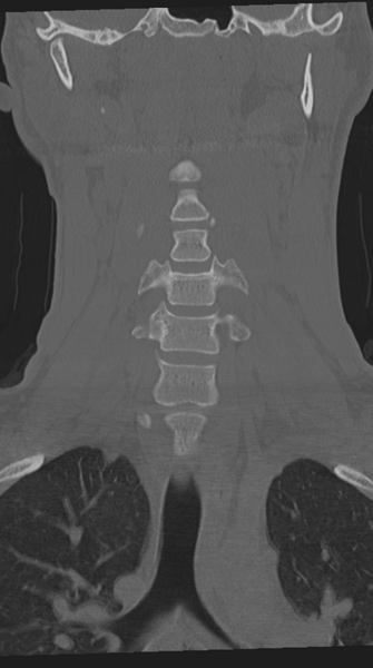 File:Cervical intercalary bone (Radiopaedia 35211-36748 Coronal bone window 29).png