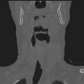 Cervical spine ACDF loosening (Radiopaedia 48998-54071 Sagittal bone window 1).png