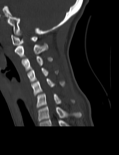 File:Cervical spine posterior ligamentous complex rupture (Radiopaedia 63486-72101 Sagittal bone window 9).jpg
