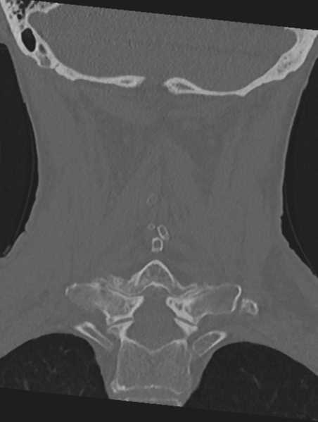 File:Cervical spondylolysis (Radiopaedia 49616-54811 Coronal bone window 38).png