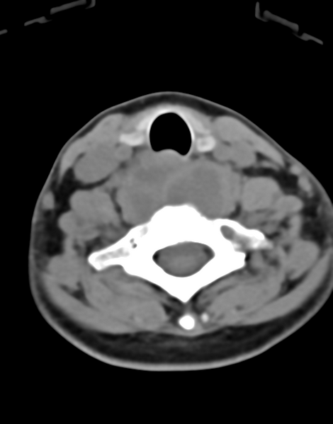 File:Cervical tuberculous spondylitis (Radiopaedia 39149-41365 Axial non-contrast 39).png