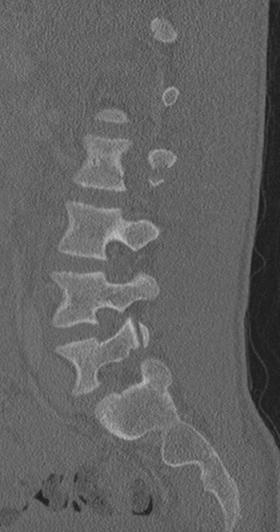 File:Chance fracture (Radiopaedia 40360-42912 Sagittal bone window 37).png