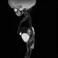 Chiari II malformation with spinal meningomyelocele (Radiopaedia 23550-23652 Sagittal T2 10).jpg