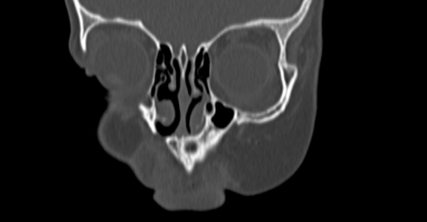 Choanal atresia (Radiopaedia 51295-56972 Coronal bone window 1).jpg