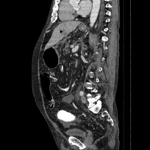 File:Cholangitis and abscess formation in a patient with cholangiocarcinoma (Radiopaedia 21194-21100 B 8).jpg