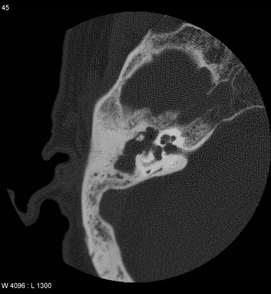 File:Cholesteatoma (Radiopaedia 5467-7197 Axial bone window 5).jpg