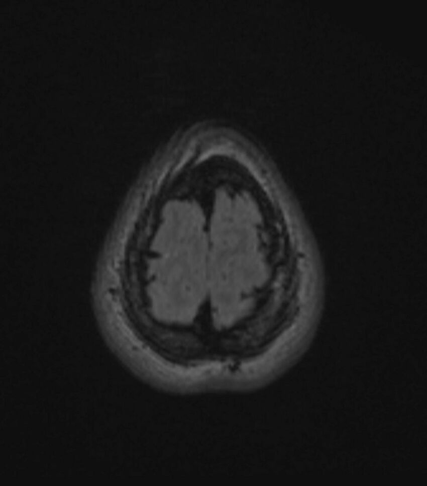 Choroid plexus carcinoma (Radiopaedia 91013-108553 Axial FLAIR C+ 195).jpg