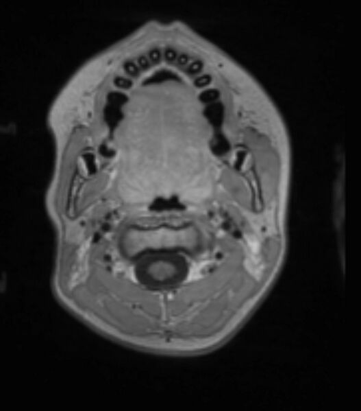 File:Choroid plexus carcinoma (Radiopaedia 91013-108553 Axial T1 C+ 48).jpg