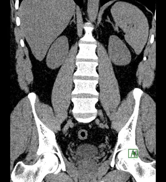 File:Chromophobe renal cell carcinoma (Radiopaedia 84286-99573 Coronal non-contrast 115).jpg