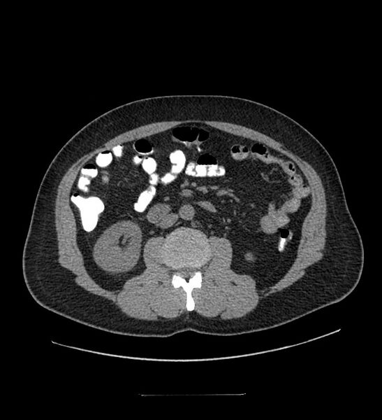 File:Chromophobe renal cell carcinoma (Radiopaedia 84337-99644 Axial non-contrast 52).jpg
