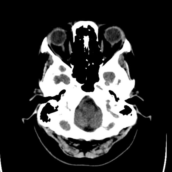 File:Chronic bilateral occipital lobe infarcts (Radiopaedia 31276-31996 Axial non-contrast 7).jpg