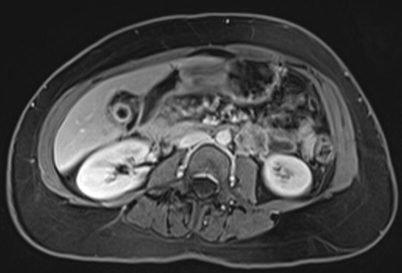 File:Chronic pancreatitis - pancreatic duct calculi (Radiopaedia 71818-82250 Axial T1 C+ fat sat 41).jpg