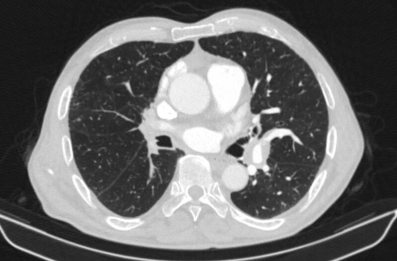 File:Chronic pulmonary embolism (Radiopaedia 91241-108843 Axial lung window 46).jpg