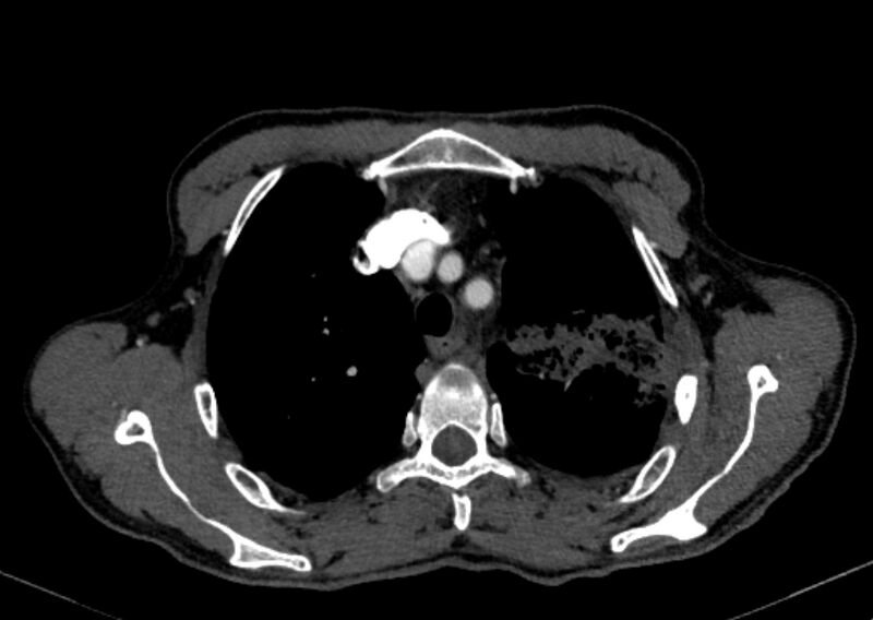 File:Chronic pulmonary embolism with bubbly consolidation (Radiopaedia 91248-108850 C+ arterial phase 27).jpg