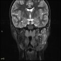 Chronic reactive multifocal osteomyelitis (CRMO) - mandible (Radiopaedia 56405-63069 Coronal STIR 20).jpg