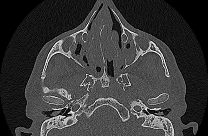 File:Chronic rhinosinusitis (Radiopaedia 65079-74075 Axial bone window 33).jpg