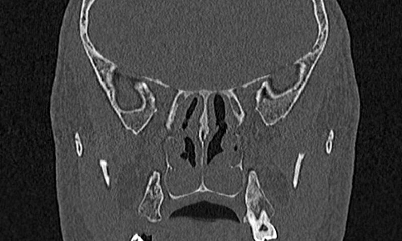 File:Chronic rhinosinusitis (Radiopaedia 65079-74075 Coronal bone window 58).jpg