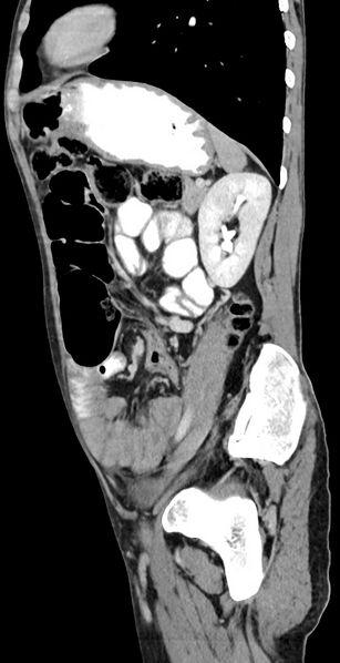 File:Chronic small bowel volvulus (Radiopaedia 75224-86322 C 50).jpg