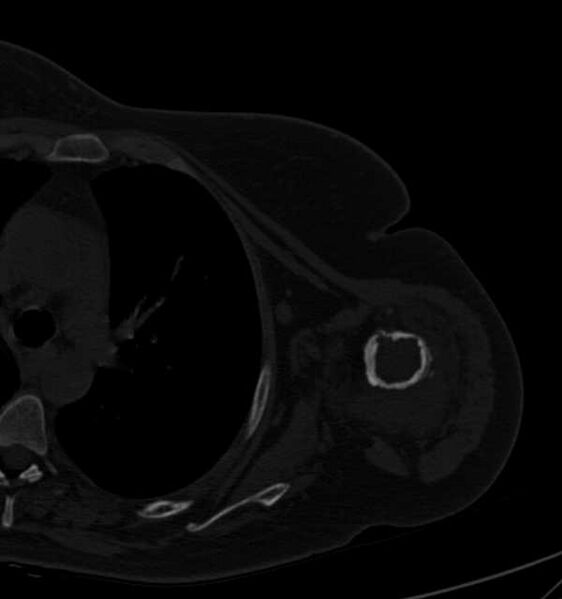 File:Clear cell chondrosarcoma - humerus (Radiopaedia 63104-71612 Axial bone window 64).jpg
