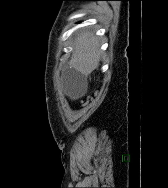 File:Closed-loop small bowel obstruction-internal hernia (Radiopaedia 78439-91096 C 128).jpg