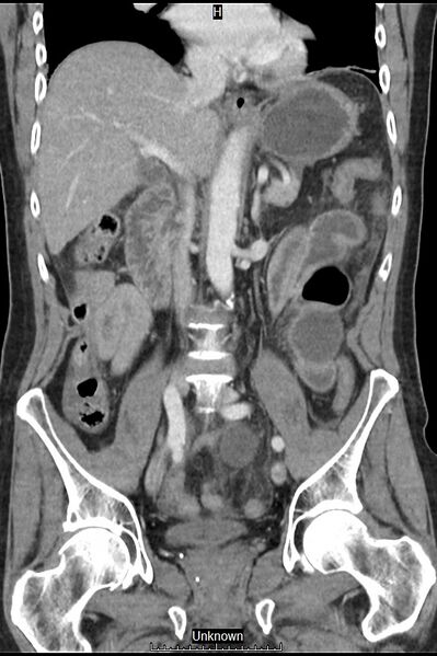 File:Closed loop bowel obstruction and ischemia (Radiopaedia 86959-103180 B 22).jpg