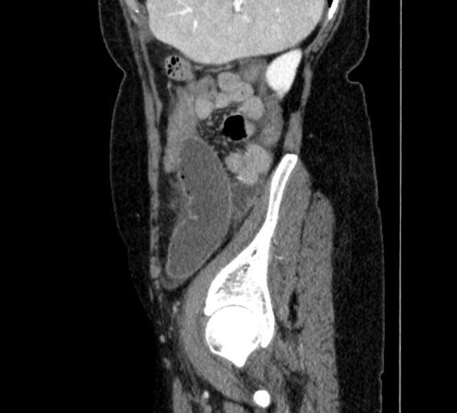 File:Closed loop small bowel obstruction (Radiopaedia 71211-81508 C 140).jpg