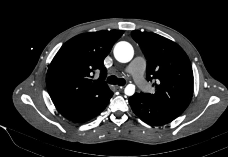File:Coarctation of aorta with aortic valve stenosis (Radiopaedia 70463-80574 A 61).jpg