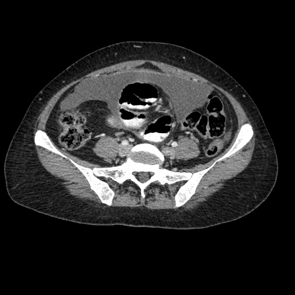 File:Cocoon abdomen with possible tubo-ovarian abscess (Radiopaedia 46235-50636 A 31).png
