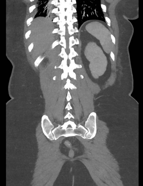 File:Colonic pseudo-obstruction (Radiopaedia 79752-92980 B 48).png