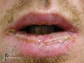 Erythema multiforme of lips (DermNet NZ reactions-em-lips1).jpg