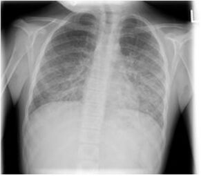 Chest X-ray demonstrating bilateral pulmonary infiltrates caused by pneumocystis pneumonia.