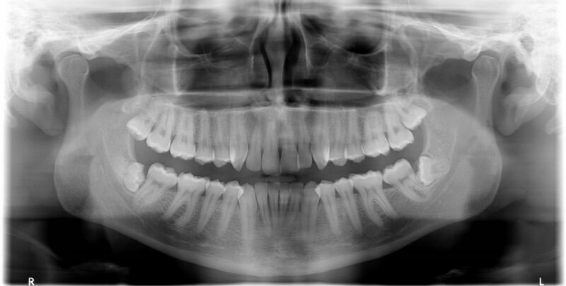 File:Impacted wisdom teeth (OPG) (Radiopaedia 42336).jpg