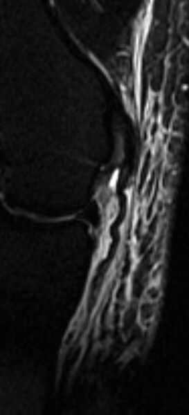 File:Medial collateral ligament tear (Radiopaedia 15313).jpg