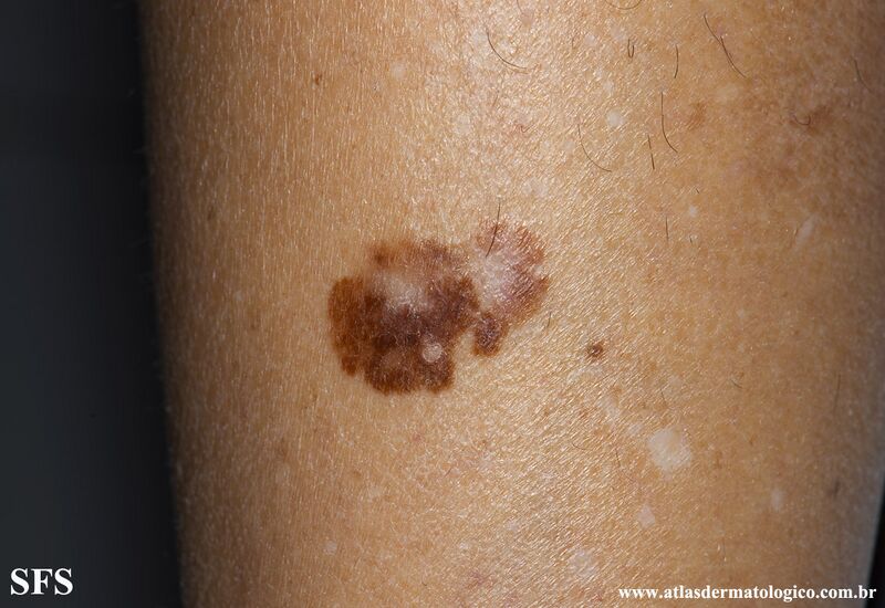 File:Melanoma (Dermatology Atlas 104).jpg