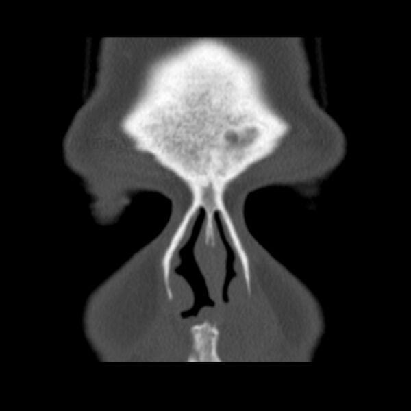 File:Nasolabial cyst (Radiopaedia 33987-35205 Coronal bone window 21).jpg